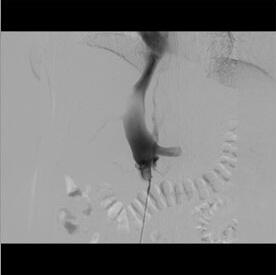 転移性肝腫瘍による下大静脈狭窄に対するステント留置術治療前画像