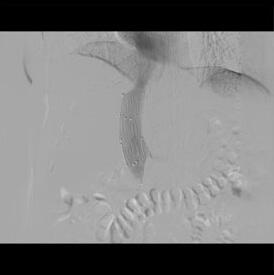 転移性肝腫瘍による下大静脈狭窄に対するステント留置術治療後画像